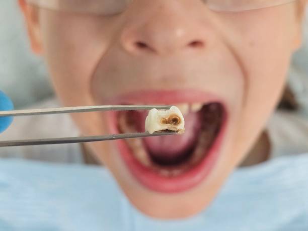 Best Emergency Treatment for Toothache in Panora, IA